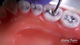 Carving my first Class I Dental Amalgam Restoration ASMR Commentary and Tips [upl. by Ornstead]