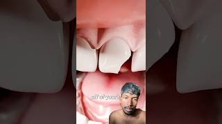 Fixing A Chipped Toothshortsviral facts science [upl. by Hollister865]