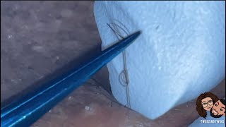 Ingrown Hair Removal Ep28 [upl. by Drucy207]