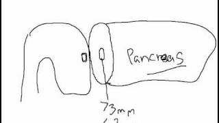 Whipple Procedure Pancreatic Anastomotic Techniques Part  1 [upl. by Lepine677]