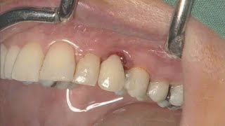 NobelActive clinical case immediate implant placement  Eric Rompen [upl. by Hightower439]