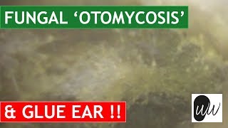 MOST CHALLENGING Otomycosis Fungal Ear Infection Removal from Ear with Glue Ear  370 [upl. by Sherill]