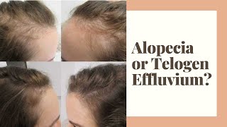 Alopecia or Telogen Effluvium [upl. by Ocnarfnaig]