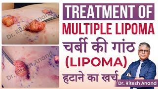 ✅What is the Treatment of Multiple Lipoma चर्बी की गांठ Lipoma  हटाने का खर्च  Scarless Surgery [upl. by Denman]