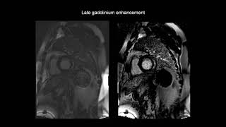 How to assess myocarditis with the help of cardiac MRI CMR [upl. by Ahsinam171]