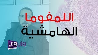 سرطان الغدد اللمفاوية لمفوما المنطقة الهامشية [upl. by Greerson]