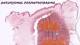 Aneurysmal dermatofibroma dermatofibroma with internal hemorrhage pathology dermpath dermatology [upl. by Quillon]