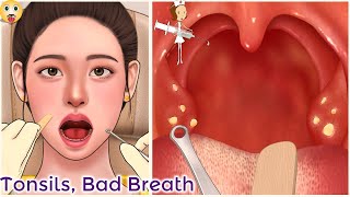 asmr tonsil stone removal animation  tonsil stone bloodborne [upl. by Misty]