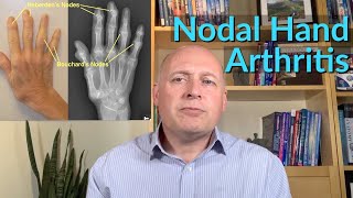 Hand amp Finger Arthritis  The Very Best SelfHelp Ideas [upl. by Evelc]