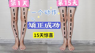 【我的O型腿矫正成功了】15天每日15分钟【一个动作针对性练习】 Oshaped leg correctionOne action persists for 15 days [upl. by Anchie628]