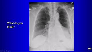 1718 Pneumomediastinum atelectasis hyperlucent hemithorax small Airways [upl. by Friedman]