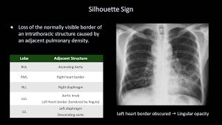 How to Interpret a Chest XRay Lesson 8  Focal Lung Processes [upl. by Nicoli987]