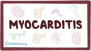 Myocarditis  causes symptoms diagnosis treatment pathology [upl. by Mandel]