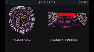 Decoding the Difference Granuloma vs Granulation Tissue [upl. by Farmann946]