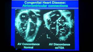 Complex Congenital Segmental Approach 44 Min Lecture [upl. by Thorner]