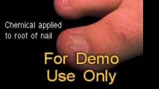 Partial Toenail Excision Phenol  Surgical Animation [upl. by Erdna]