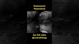 Endometrial hyperplasia  radiology radiologist doctor medicalschool ultrasound [upl. by Adaynek]