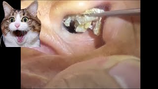 Removing impacted ear wax [upl. by Siuluj]