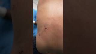 Get rid of Lipoma  Multiple Lipoma Removal shorts [upl. by Gram]