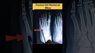 FRACTURE 5th Metatarsal Bone Xray Foot radiographerusn radiography xray bones [upl. by Lexerd]