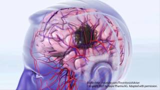 How can Atrial Fibrillation lead to STROKE [upl. by Eimilb225]