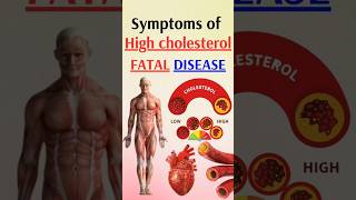 Symptoms of high cholesterol  fatal disease [upl. by Colpin]