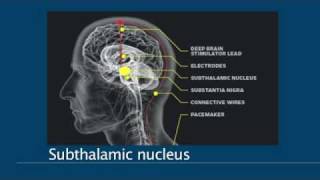 Deep Brain Stimulation  Approaches [upl. by Mag]