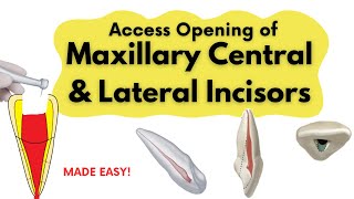 Access Opening of Maxillary Central and Lateral Incisor I Endodontics [upl. by Rigby]