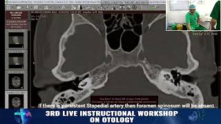 Preoperative CT scan in Otosclerosis Points to consider Prof Dr Delwar Hossain [upl. by Moselle]