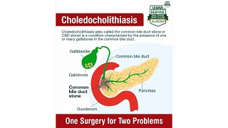 One Surgery for Two Procedures  Laparoscopic Cholecystectomy with Choledocholithotomy  Dr GS Jammu [upl. by Darrill]