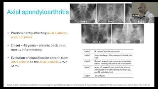 SPONDYLOARTHRITIS  APPROACH AND MANAGEMENT  DR ASHISH J MATHEW RHEUMATOLOGY [upl. by Eniar456]