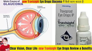 NEW TRAVISIGHT Eye Drop Review amp Glaucoma Management thepharmacistdrx travisighteyedroops [upl. by Nylemaj]