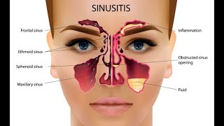 Chronic Sinusitis and just one homeopathic remedy amp 1 dose chronic sinusitis headache UrduHindi [upl. by Demott]