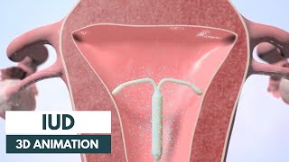 How does an IUD work  3D animation [upl. by Ecila]