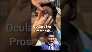 Eye prosthesis ocular prosthesis eye injury vision shorts [upl. by Stoller]