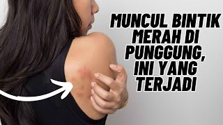 Penyebab Muncul Bintik Merah di Punggung Bahayakah [upl. by Charleen]