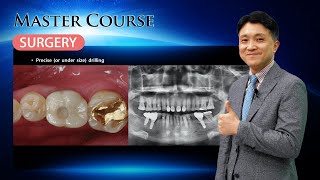 Master Course  SURGERY Immediate implant placementⅠ [upl. by Coppins906]