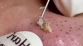 Nose Perfection Popping Giant Blackheads Up Close [upl. by Bowie]