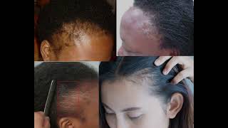 DANGERS OF HAIR BONDING GLUE [upl. by Branen]