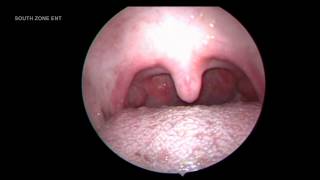 ATROPHIC TONSILS WITH GRANULAR PHARYNGITIS [upl. by Aronoff]