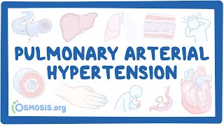 NORD  Pulmonary Arterial Hypertension [upl. by Adianes]