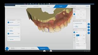 CEREC Design 7 Temporary Crown [upl. by Aihsekin]