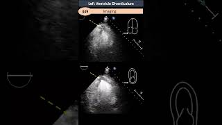 Congenital Left Ventricle Diverticulum amp Aneurysm [upl. by Lacefield]