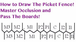 Occlusion  Picket Fence  NBDE Part 1 Boards Study [upl. by Lamori]