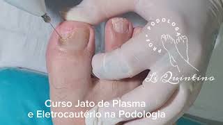 Curso Jato de Plasma e Eletrocautério na Podologia [upl. by Eamon]