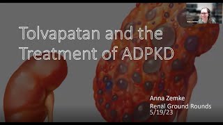 Anna Zemke MD  Tolvaptan and the Treatment of ADPKD [upl. by Bullis]