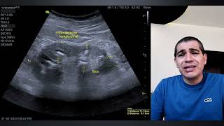 DOLOR DE ESPALDA 😣 LITIASIS RENAL MÚLTIPLES INFECCIONES URINARIAS DIABETES DESCONTROLADA [upl. by Shien]