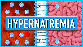 Hypernatremia  Pathophysiology Etiologies Consequences and Treatment [upl. by Nevanod]