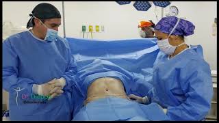 Cirugía Abdominal Abdominoplastia con Lipoescultura [upl. by Antone]