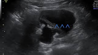 On Call USG  Dr Sanjeev Mani  URINOMA  SUBCAPSULAR  PERINEPHRIC COLLECTIONS  ACUTE RENAL COLIC [upl. by Schilling87]